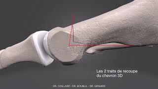 chevron 3D pour la correction de l'Hallux Valgus