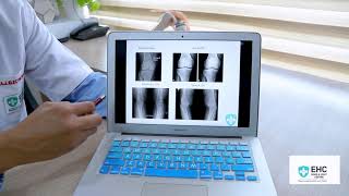 Osteoarthritis of the Knee: Classification