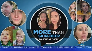 CBS4 Special Report: More Than Skin Deep