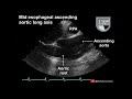 16 views to master in transesophageal echocardiography tee