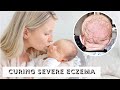 HOW I HEALED BABY ECZEMA OVERNIGHT! *SHOCKING RESULTS* | Eczema Products & Routine | Taylor Lindsay