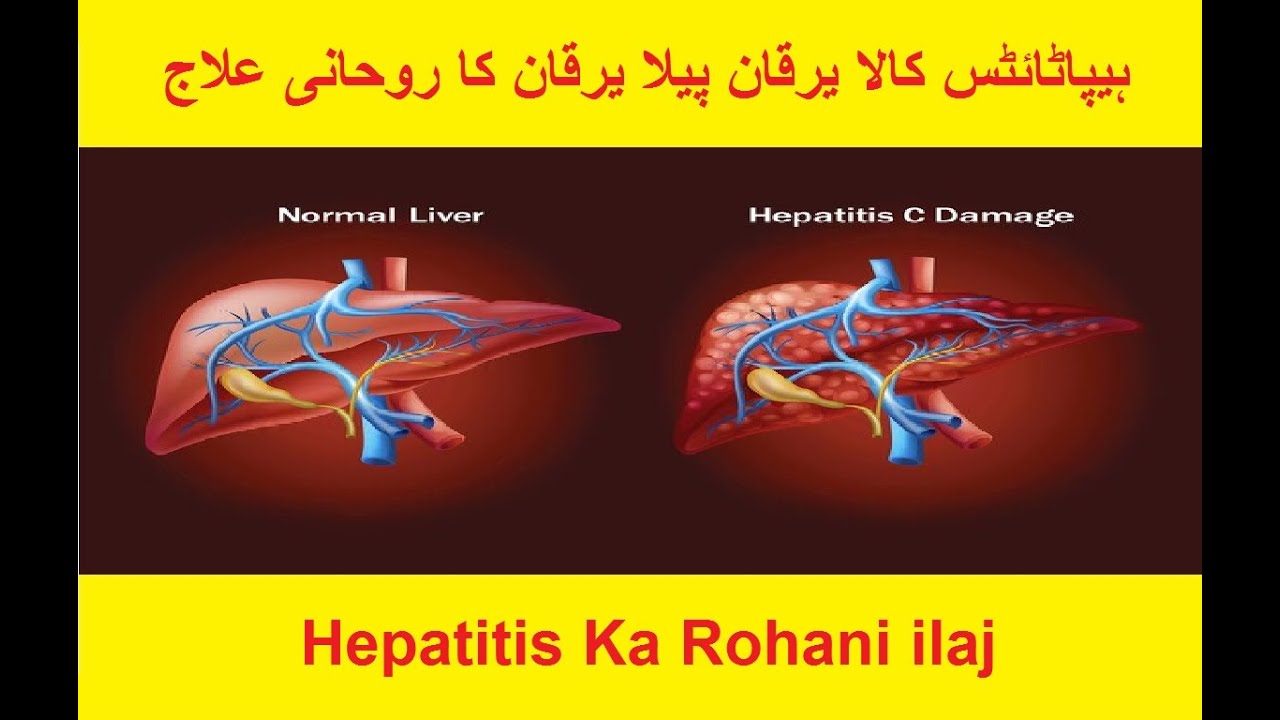 Hepatitis Ka Wazifa | Hepatitis A,B,C Ka Ilaj In Urdu | Yarkan Ka Ilaj ...