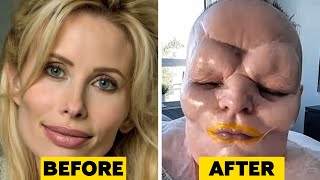 15 Times Plastic Surgery Went Horribly Wrong