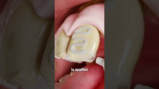 How Veneers Work 😮