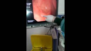 How to perform upper GI endoscopy