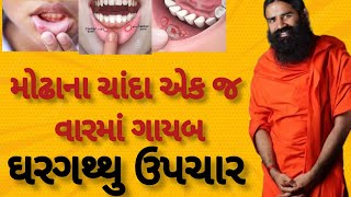 મોઢા ના ચાંદા માટે ઘરગથ્થુ ઉપચાર mouth Ulcer #ayurveda