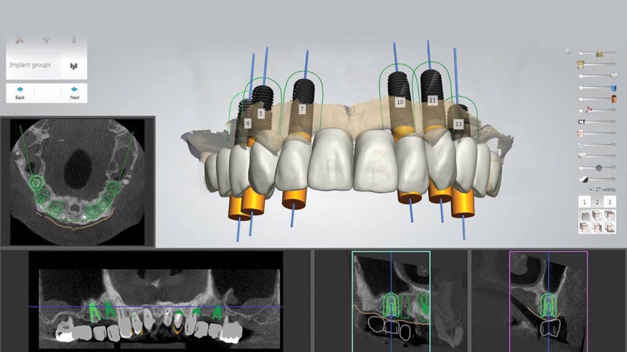 Immediate Delivery Of A CAD/CAM-Milled BioTemps® Full-Arch Implant ...