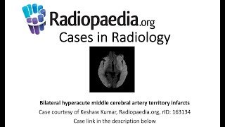 Bilateral hyperacute middle cerebral artery territory infarcts (Radiopaedia.org) Cases in Radiology