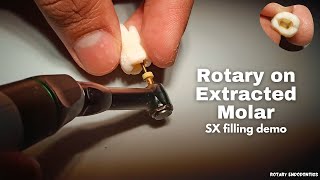 Rotary Filing (SX) on Molar | Some tips for doing Rotary Endodontics