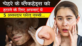 चेहरे के ब्‍लैकहेड्स हटाने के लिए 5 असरदार घरेलू नुस्खे | Home Remedies for Blackheads