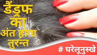 रूसी को जड़ से ख़त्म करने के आयुर्वेदिक घरेलू उपाय... Aayurveda online