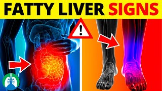 ⚡ Top 10 Signs and Symptoms of Fatty Liver You MUST AVOID