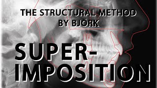 How to: Superimposition of lateral cephalogram - by Björk