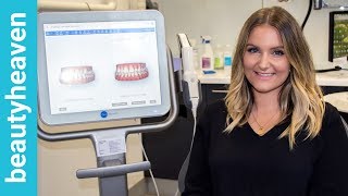 My Invisalign journey : Getting started