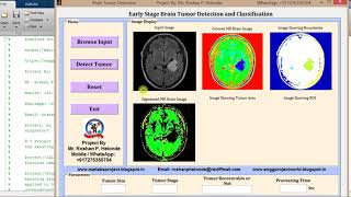 Early Brain Tumor Detection using matlab