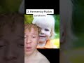 The 4 Types of Albino skin conditions #albino #albinos #skin