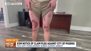 Man to sue Phoenix for $15 million due to burn injuries during arrest