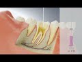 Achieving Patency with Bassi Logic - Conservative Endodontics