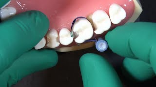 The Double Band Technique for Deep Margin Elevation (DME) | Dr. JD Corey