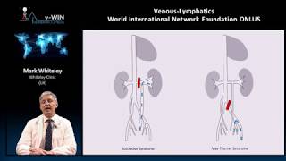 Pelvic congestion syndrome explained by Prof Mark Whiteley