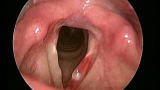 submucosal hemorrhage and edema of left vocal fold, (左聲帶黏膜下出血發炎水腫 )