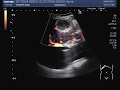 Ultrasound Video showing multiple stones and a mass in Gall bladder.