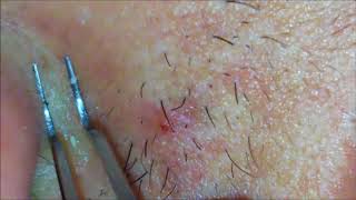 blackhead　whitehead 【閲覧注意】