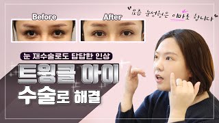 (ENG) 요즘 눈재수술은 이마로?! 눈썹과 눈사이가 좁고 두툼하다면 쌍수보다 트윙클아이가 적합합니다. Plastic eye surgery involves  forehead