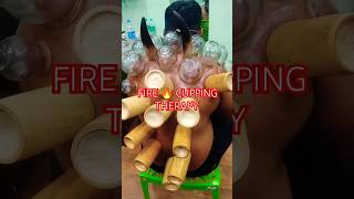 Fire 🔥 Cupping For Muscles Pain Relief 💪#fire #firecupping #hijama #cupping #tranding #viral #shorts