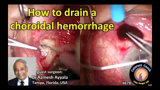 how to drain a choroidal hemorrhage