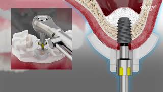 OneCAS KIT - Digitally Guided Sinus Lifts