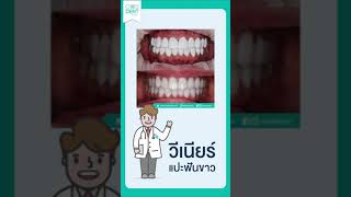 วิธี สังเกตุวีเนียร์ชำรุด ระวังฟันเน่า #shorts COSDENT SMILE DESIGN