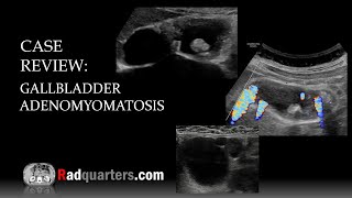 Ultrasound of Gallbladder Adenomyomatosis