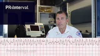 Ventricular Fibrillation (V-Fib) (ECG Rhythm Interpretation)