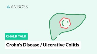 Crohn’s disease and ulcerative colitis: Differences