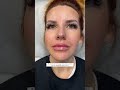 Thin lips lip filler transformation