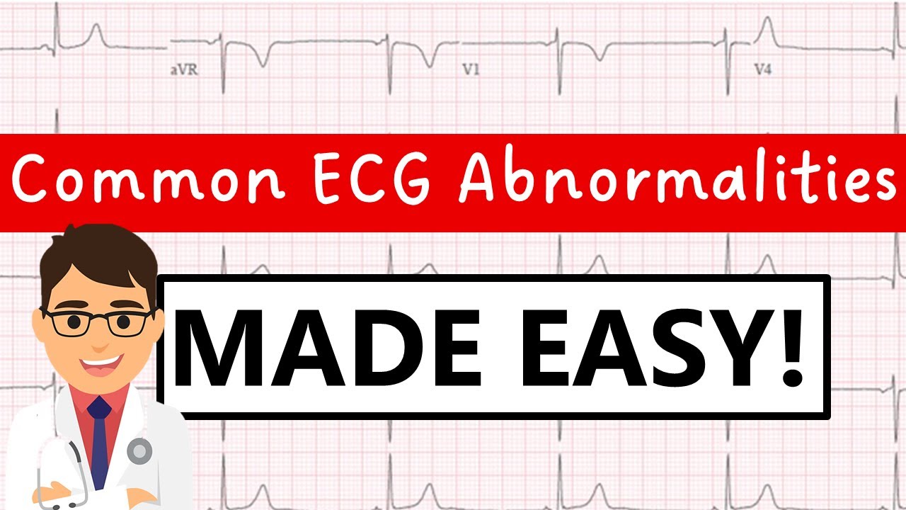 Decode Any Ecg Your Chart Of Common Abnormalities Rhythms