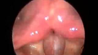 vocal fold leukoplakia, post-op (聲帶白斑,術後)