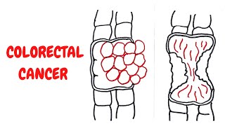 COLORECTAL CANCER II GIT II ROBBINS 10TH E II PATHOLOGY LECTURES II @DrJIBRANAHMED