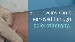 Safely Remove Spider Veins with Sclerotherapy