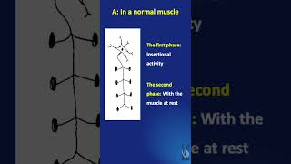 Shorts #27: EMG activities after nerve injury - in normal, denervated \u0026 re-innervating muscles!