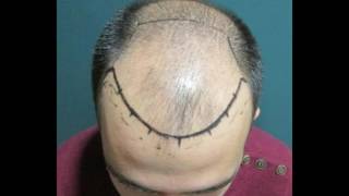 Hair transplant-Before and After 3500 Grafts