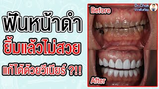 ฟันดำ ปลายฟันไม่เท่ากัน แก้ด้วยวีเนียร์ พี่หมอทำอย่างไร ?!! | คลายปัญหารากฟันเทียมกับหมอโชค