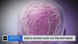 What are the symptoms and signs of a seizure?