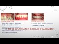 teaching hunt contestant no 18 gingival enlargement dr. b.nikitha