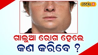 ଗାଲୁଆ ରୋଗ ହେଲେ କଣ କରିବେ ? ।Parotid gland । Baleswar । Odia News।#local18