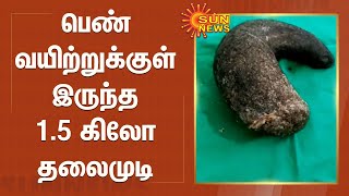 பெண் வயிற்றுக்குள் இருந்த 1.5 கிலோ தலைமுடி | 1.5 kg of hair inside the woman's abdomen | Karnataka