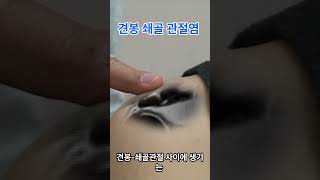 어깨 통증의 숨은 원인! 견봉쇄골 관절염 해부와 치료 Hidden Shoulder Pain! Unveiling AC Joint Arthritis \u0026 Treatment