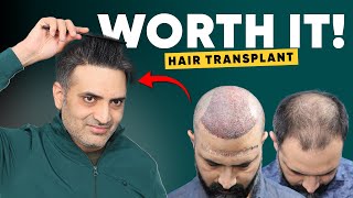 Hair Transplant in Jaipur | Best Results \u0026 Cost of Hair Transplant in Jaipur