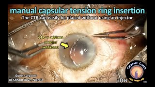 CataractCoach 1266: manual CTR capsular tension ring insertion